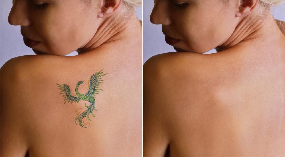 How Does Tattoo Removal Actually Work Bopp Dermatology Facial Plastic Surgery