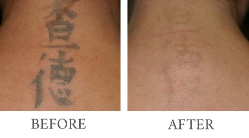 laser tattoo removal before and after