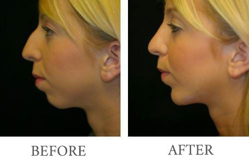 Chin Augmentation before and after