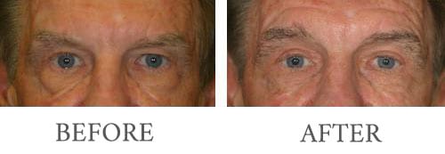 Eyelid surgery before and after
