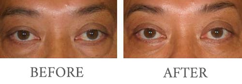 eyelid surgery before and after 2