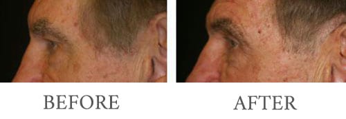 Eyelid Surgery before and after 3