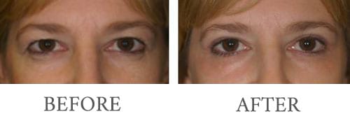 Eyelid surgery before and after 5