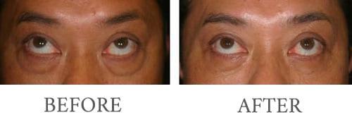 Eyelid surgery before and after 7