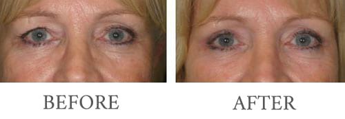 Eyelid surgery before and after 8