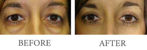 Eyelid surgery before and after 9