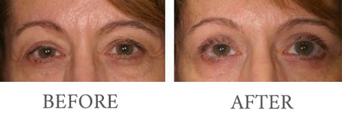 Eyelid surgery before and after 10