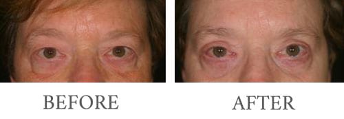 Eyelid surgery before and after 11