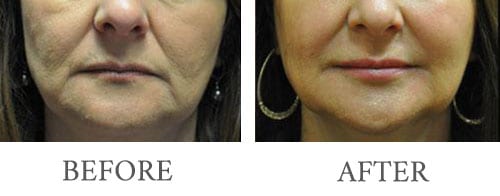 filler injectables before and after