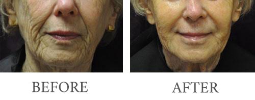 Filler Injectable before and after