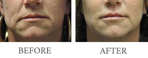 filler injectables before and after 3
