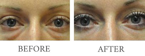 Filler Injectable before and after