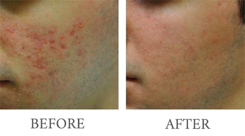 Laser Genisis before and after