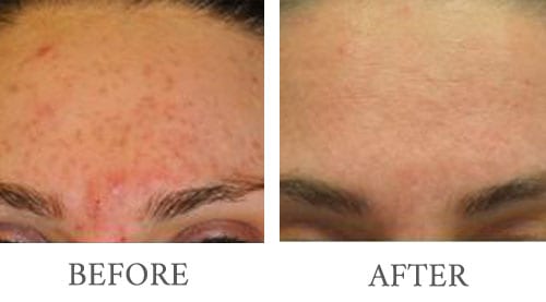 Laser Genisis before and after