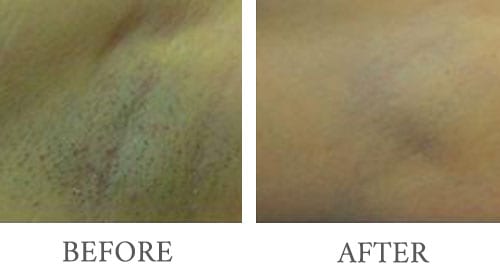 Laser Hair Removal before and after