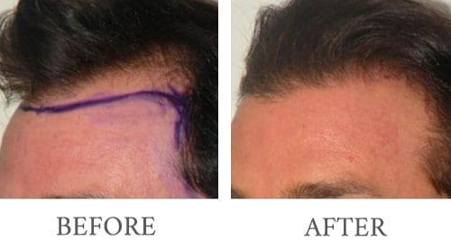 Hair Transplant before and after 2