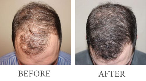 Hair Transplant before and after 4