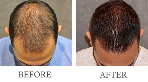 Neograft Hair Transplant before and after