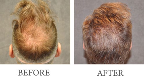 Hair Transplant before and after 11