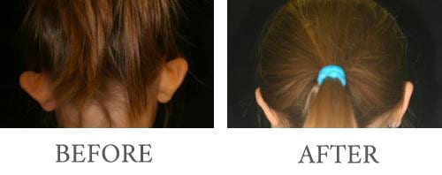 Otoplasty Ear Alteration before and after