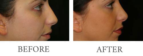 rhinoplasty before and after 1