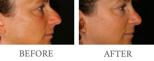 rhinoplasty before and after 2
