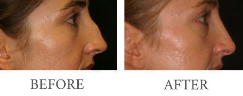 rhinoplasty before and after 3