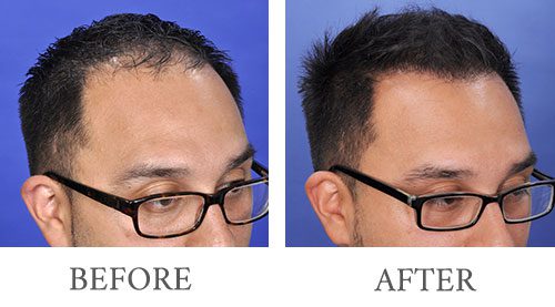 Hair Transplant before and after 14