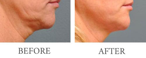 ultherapy before and after 2
