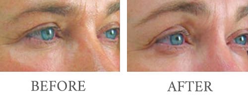 ultherapy before and after 3