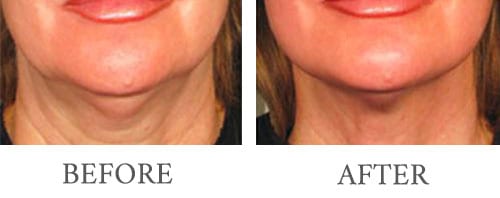 ultherapy before and after 4