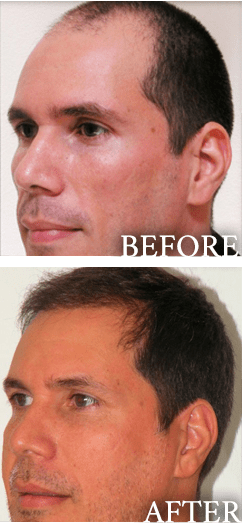 before and after hair transplant