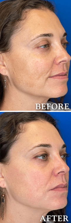 VIRTUE RADIOFREQUENCY/MICRONEEDLING BEFORE AND AFTER