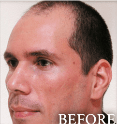 before hair transplant