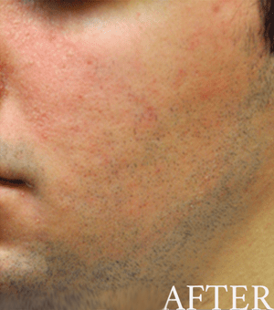before and after rosacea treatment