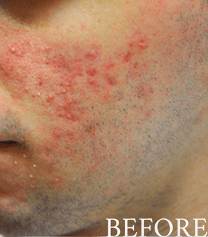 before and after rosacea treatment